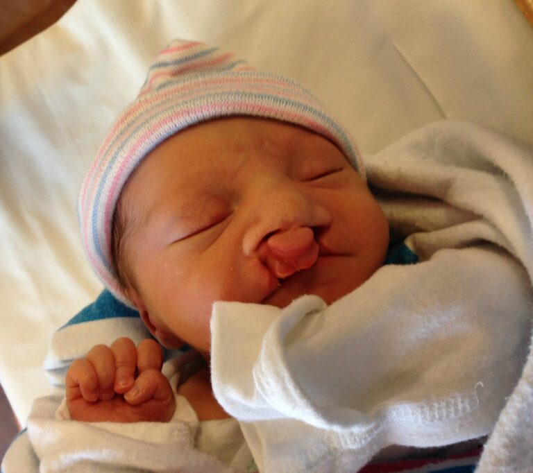bilateral cleft lip